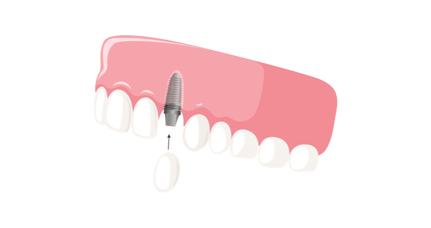 Dental implants Perth Alpha Dental