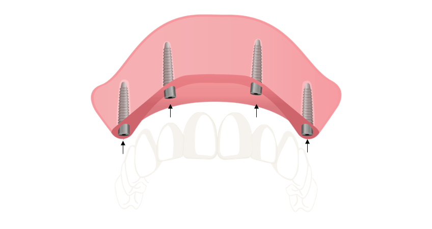 All-on-4- dental-implants- Perth
