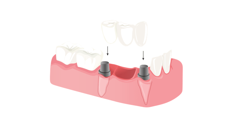 Dental implants Bridge Perth Alpha Dental